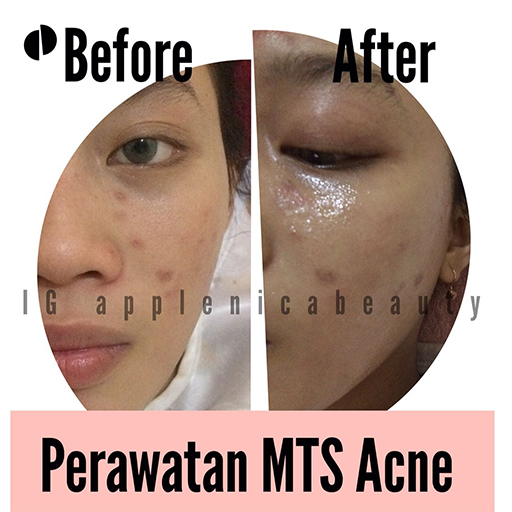 3x BB Glow Treatment