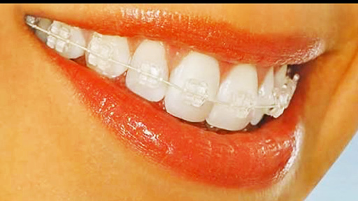  Behel Transparan dari Klinik Gigi Global Estetik