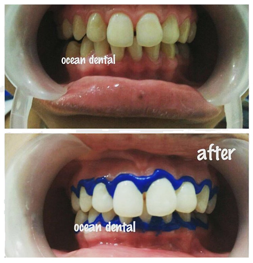  Paket Perawatan Gigi dari Ocean Dental Kramat Jaya 02