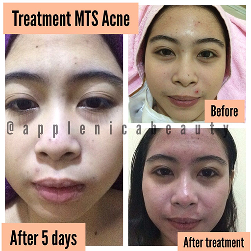 3x BB Glow Treatment