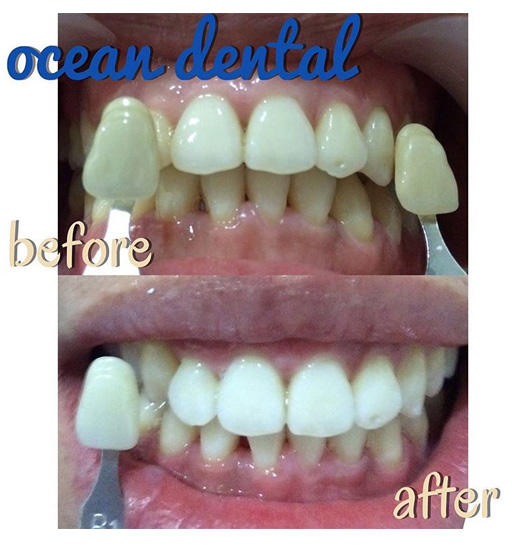  Paket Perawatan Gigi dari Ocean Dental Kramat Jaya 02