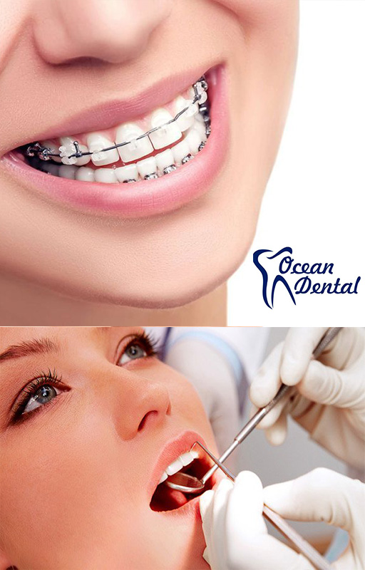  Paket Perawatan Gigi dari Ocean Dental Kramat Jaya 02