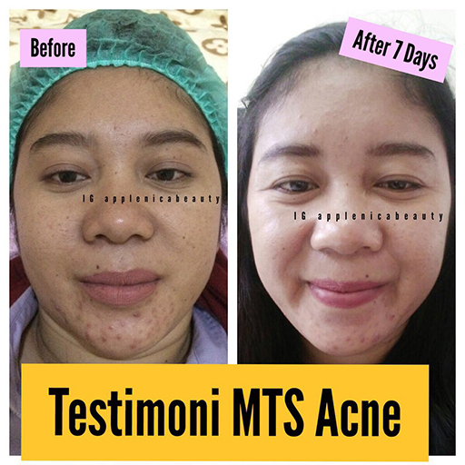 3x BB Glow Treatment