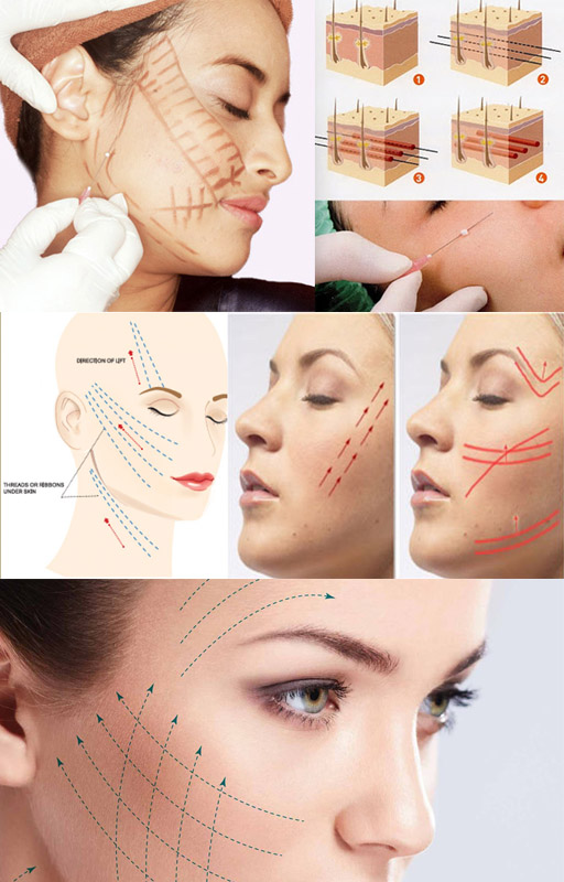  Perawatan Tanam Benang dari Aisyiah Beauty Clinic
